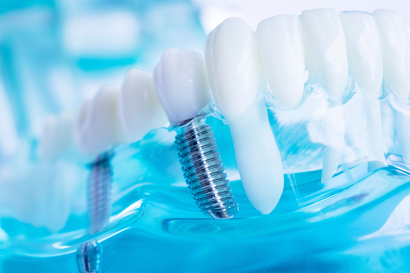 Sunrise Dental | Implant Dentistry, Dentures and Invisalign reg 